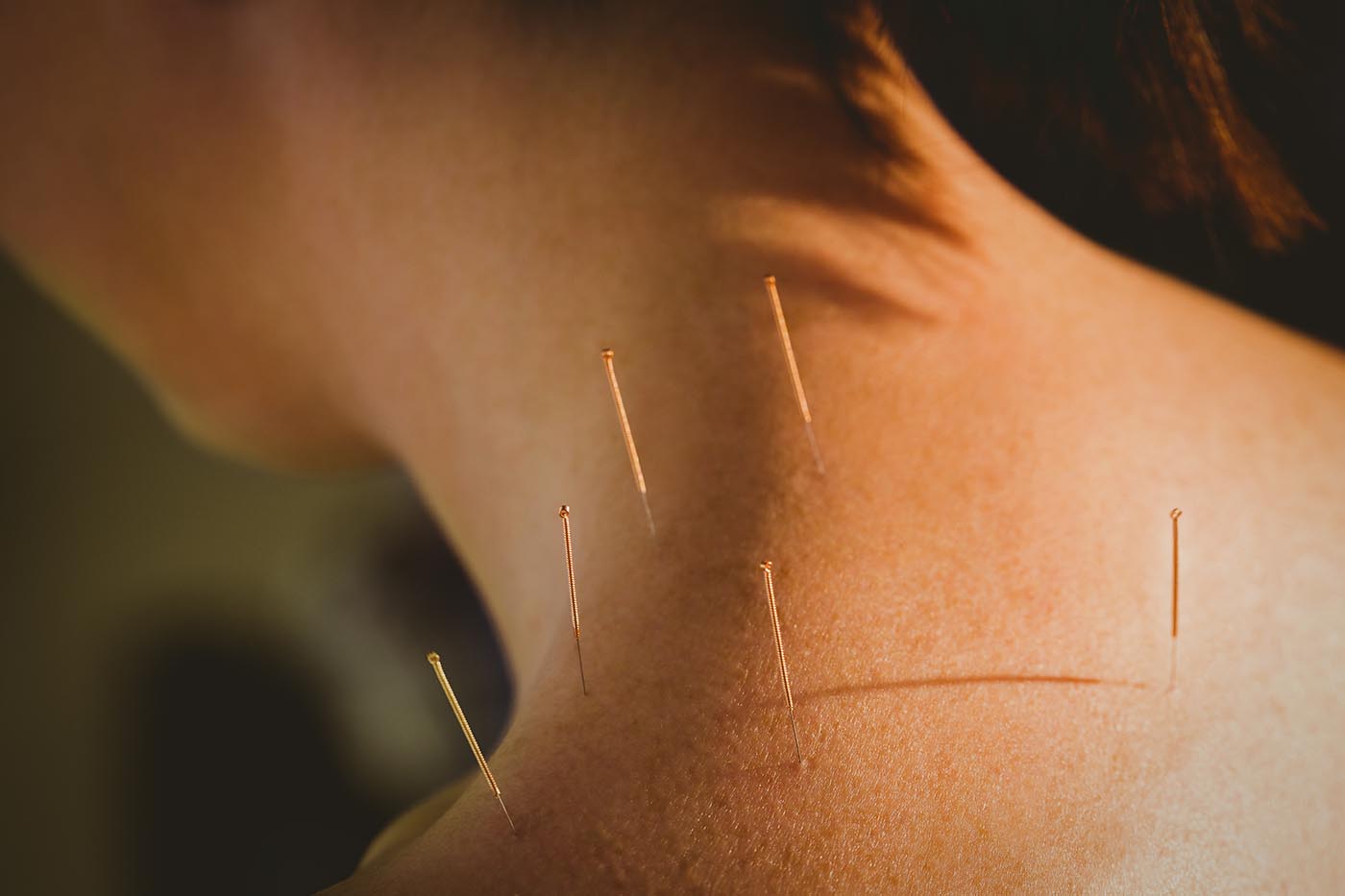 what-are-the-benefits-of-acupuncture-march-with-us