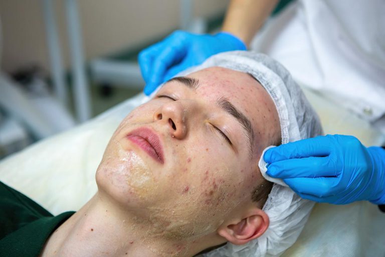 What causes acne? | What are the various types of acne? | Treatments?